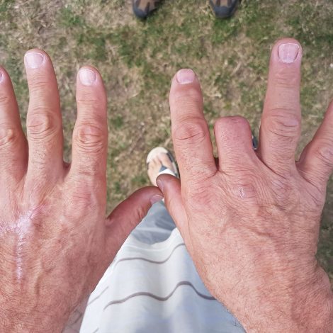 Mozambique Spitting Cobra bite.