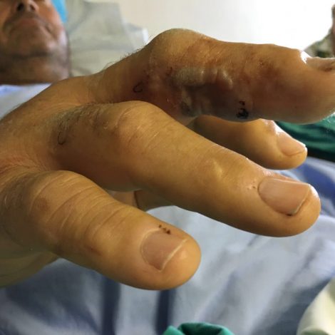 Survivor Bitten By Mozambique Spitting Cobra Shares Harrowing Story