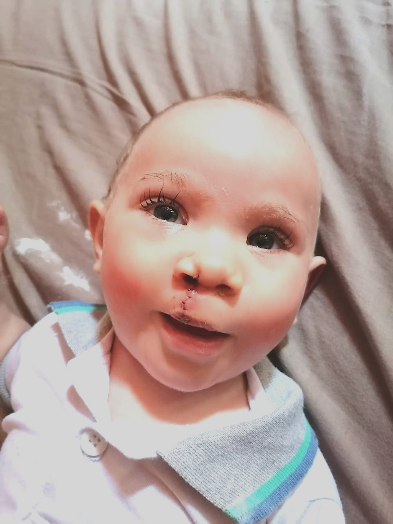 Netcare Foundation enables cleft and palate procedures that will transform Hanru’s life.